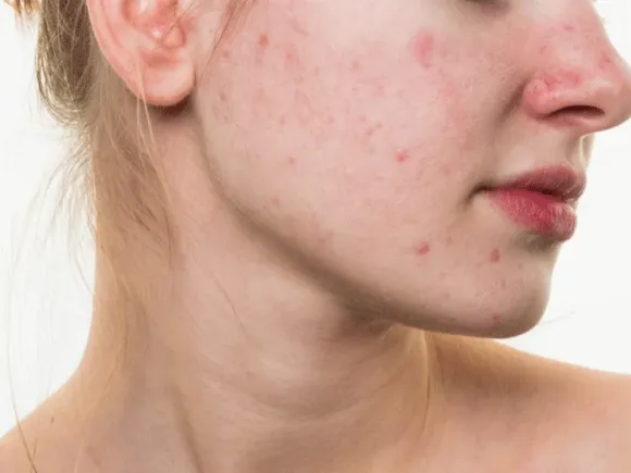 Mụn Viêm Có Nên Nặn Không? Chuyên Gia Da Liễu Giải Đáp Chi Tiết